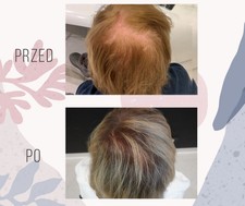 efekt-przeszczepionych włosów u kobiety przed po